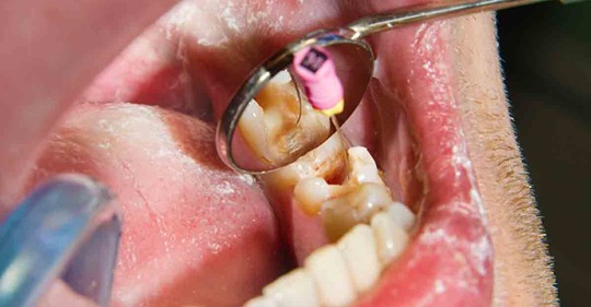 Could a Root Canal Be the Cause of Your Chronic Health Problem?